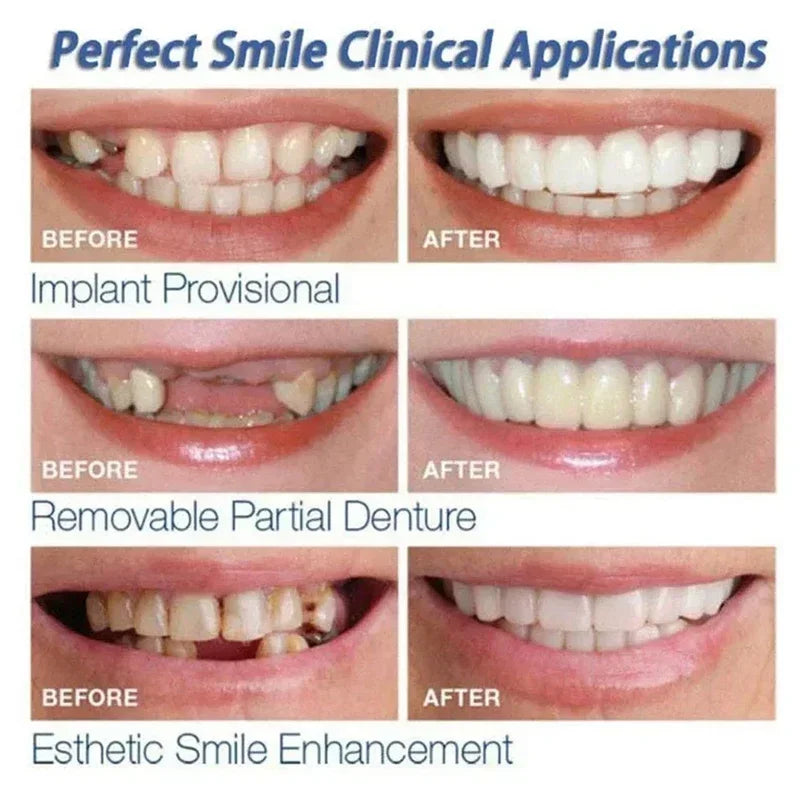 Daily Smile Veneer Snap-on Teeth Kit for Temporary Tooth Replacement