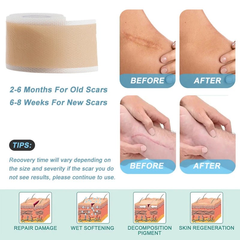 Skin Care Silicone Gel Scar Patch for Invisible Scar Cover and Repair